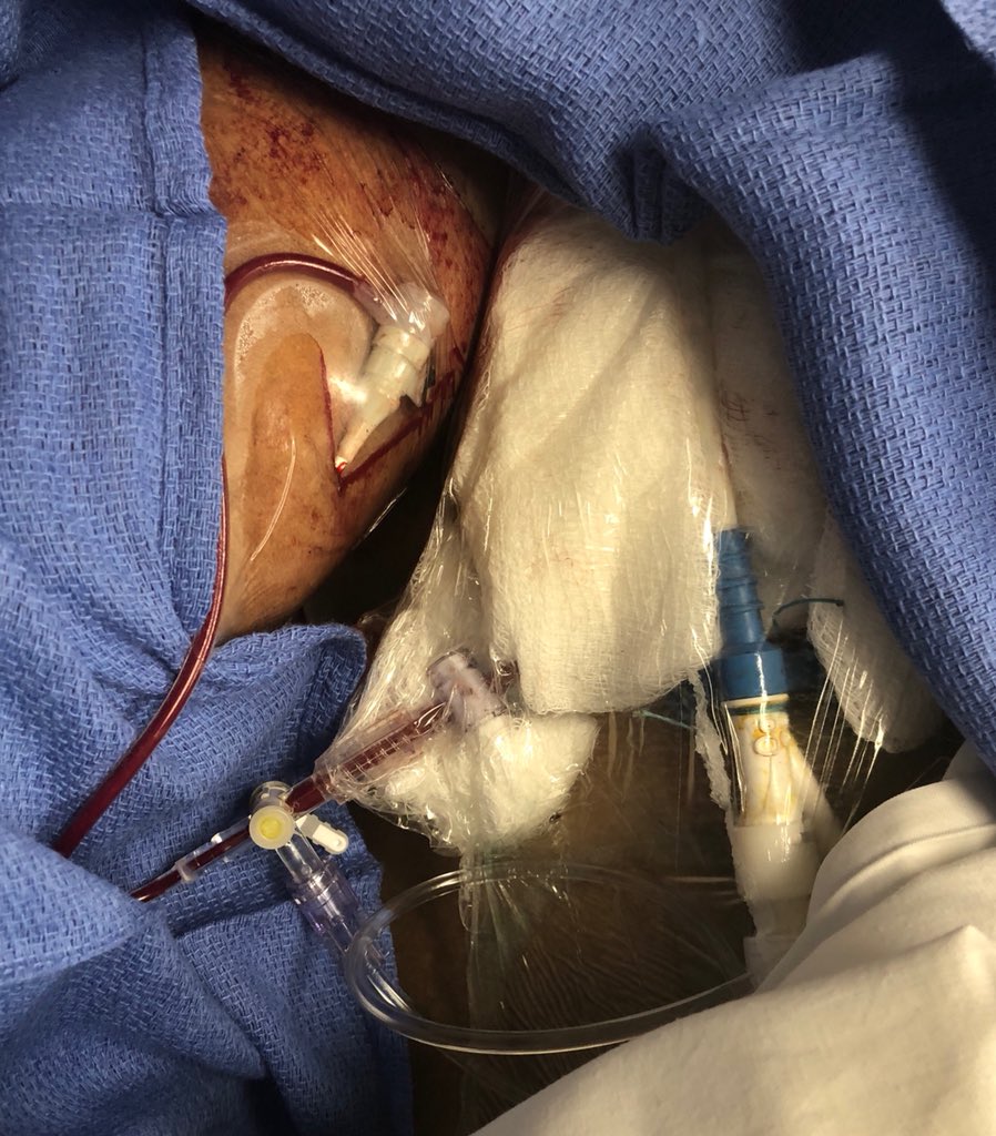DrAmirKaki's tweet image. CGS with severe 3VD on 2 pressors.  LVEDP 60mmHG.  On CP stopped pressors and dropped to 42mmHG and 2 hours laters 18mmg.  Transferred due to hostile illiac dz. #PercAx with pre emptive antegrade brachial conduit.  #NCSI #waronshock