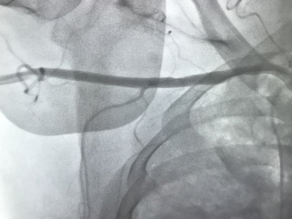 DrAmirKaki's tweet image. CGS with severe 3VD on 2 pressors.  LVEDP 60mmHG.  On CP stopped pressors and dropped to 42mmHG and 2 hours laters 18mmg.  Transferred due to hostile illiac dz. #PercAx with pre emptive antegrade brachial conduit.  #NCSI #waronshock