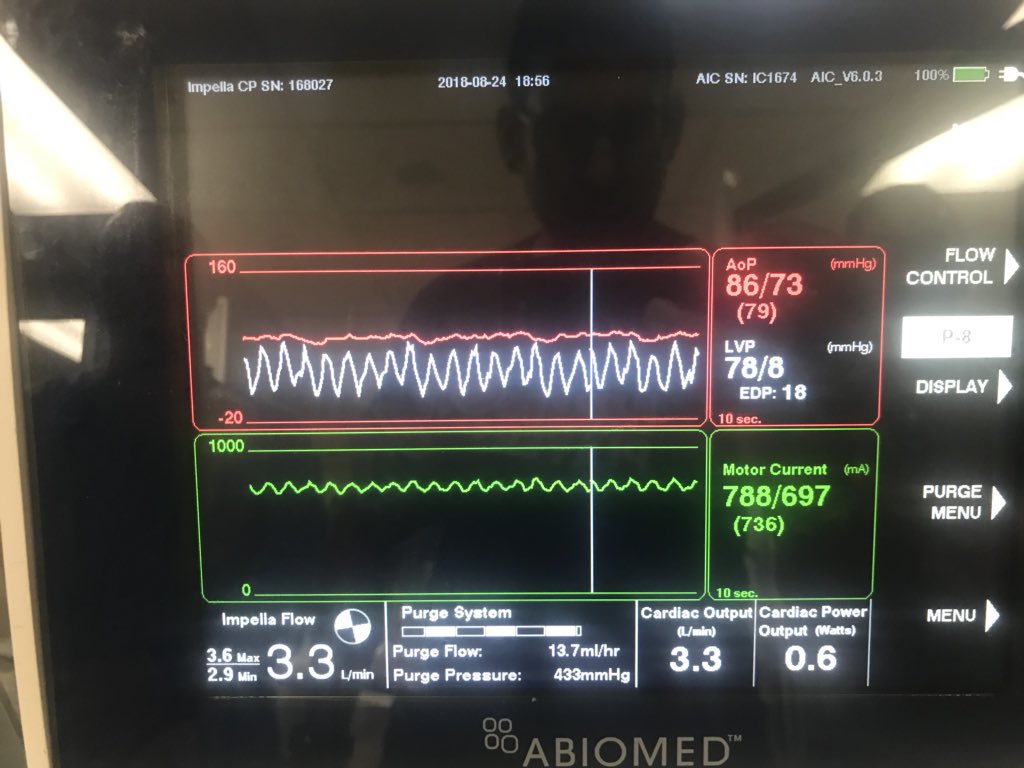 DrAmirKaki's tweet image. CGS with severe 3VD on 2 pressors.  LVEDP 60mmHG.  On CP stopped pressors and dropped to 42mmHG and 2 hours laters 18mmg.  Transferred due to hostile illiac dz. #PercAx with pre emptive antegrade brachial conduit.  #NCSI #waronshock