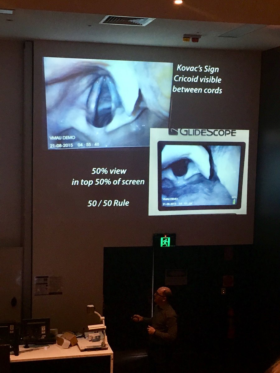 GlideScopeVL's tweet photo. Remember the 50/50 Rule for successful tube delivery with the GlideScope! @airwaycam  #videolaryngoscopy #GlideScope #firstpasssuccess #laryngoscopy #airway #difficultairway #hyperangulated https://t.co/ItftDf667Y