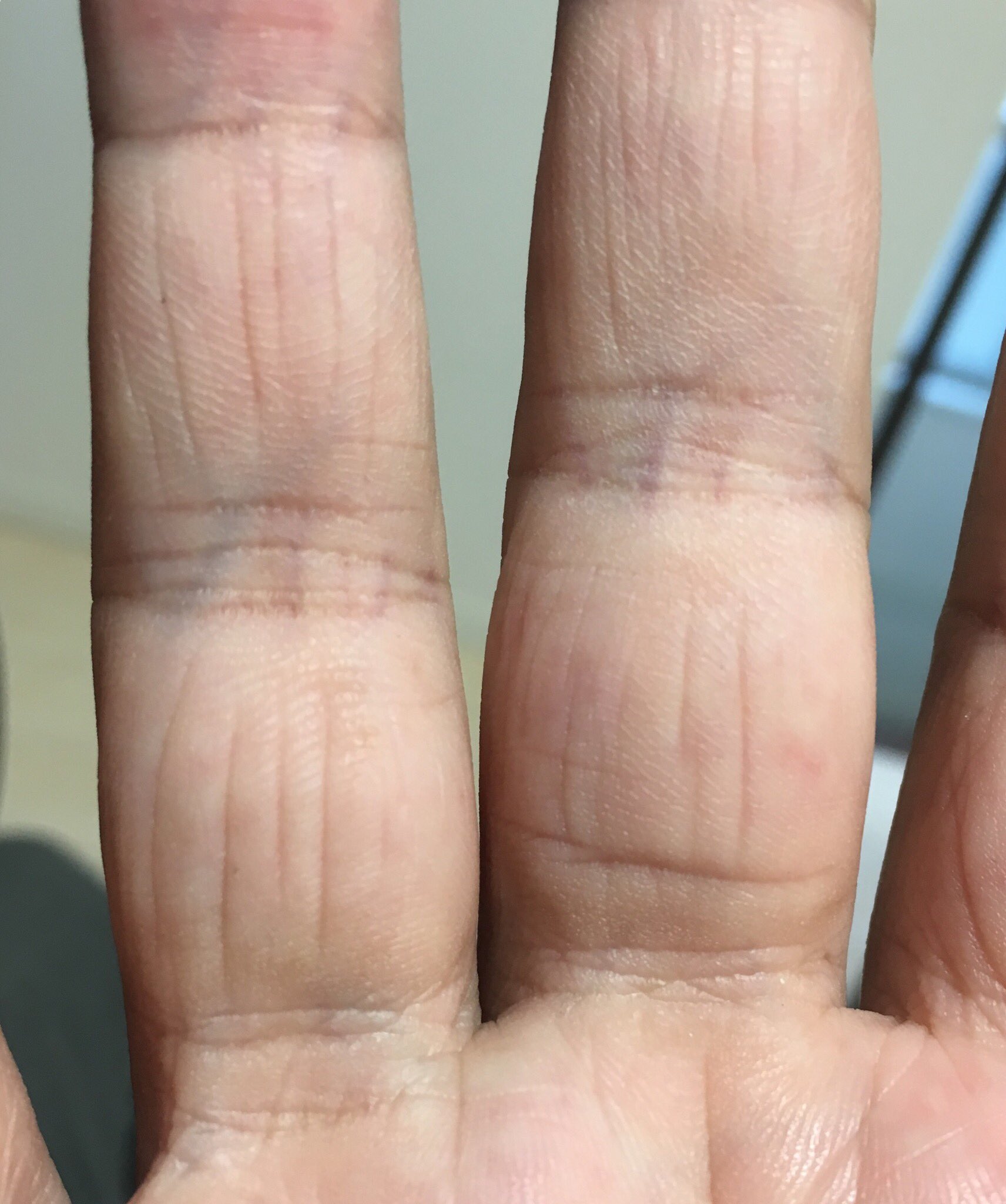 تويتر 福地翼 Goldenspiral على تويتر この指の縦じわがずっと嫌だったんだけど 調べたら 俵紋 っていう珍しい手相で 食べるのに一生困らないらしい T Co F95rcismya