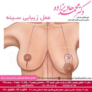 عمل زیبایی سینه

عمل زیبایی سینه به منظور داشتن سینه هایی خوش فرم متناسب با آناتومی بدن انجام می شود که با تغییر سایز و موقعیت پستان و کوچک یا حجیم کردن و بالا کشیدن سینه صورت می گیرد...ادامه مطلب: doctor-hadizadeh.com/%d8%b9%d9%85%d…