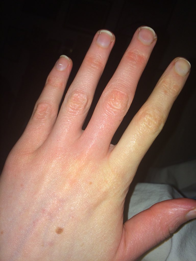 Phoebe on Twitter "My ME is usually invisible, apart from