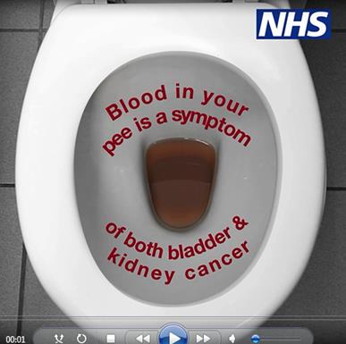 Blood in urine cancer warnings to appear in men's toilets - BBC News