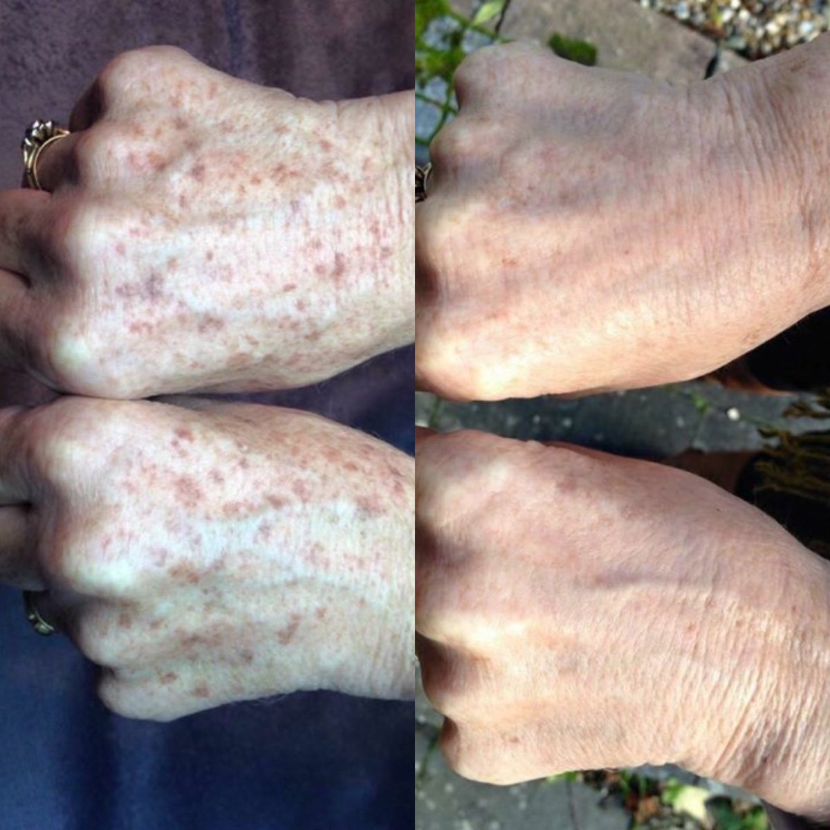 🌒IPL PhotoRejuvenation Vs Brown spots🌔
   •Results 💡 Prevention 💡sarahdaleaesthetics.com 
☎️01305 269220 
#sundamage #onetreatment #skinrejuventation#resultsdriven #medicalaesthetics #nhs ipl #laser #venusfreeze #ellipseclinic #loveyourhands