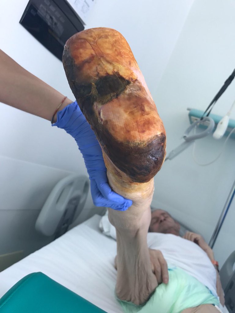 diabeticfoot1's tweet image. Patients admitted today: is the late referral still acceptable? We are not an amputation prevention centre! Today we are an amputation centre @dgarmstrong @jmills1955 @monteromiguel @antoniomunoa @hendolat @andycas