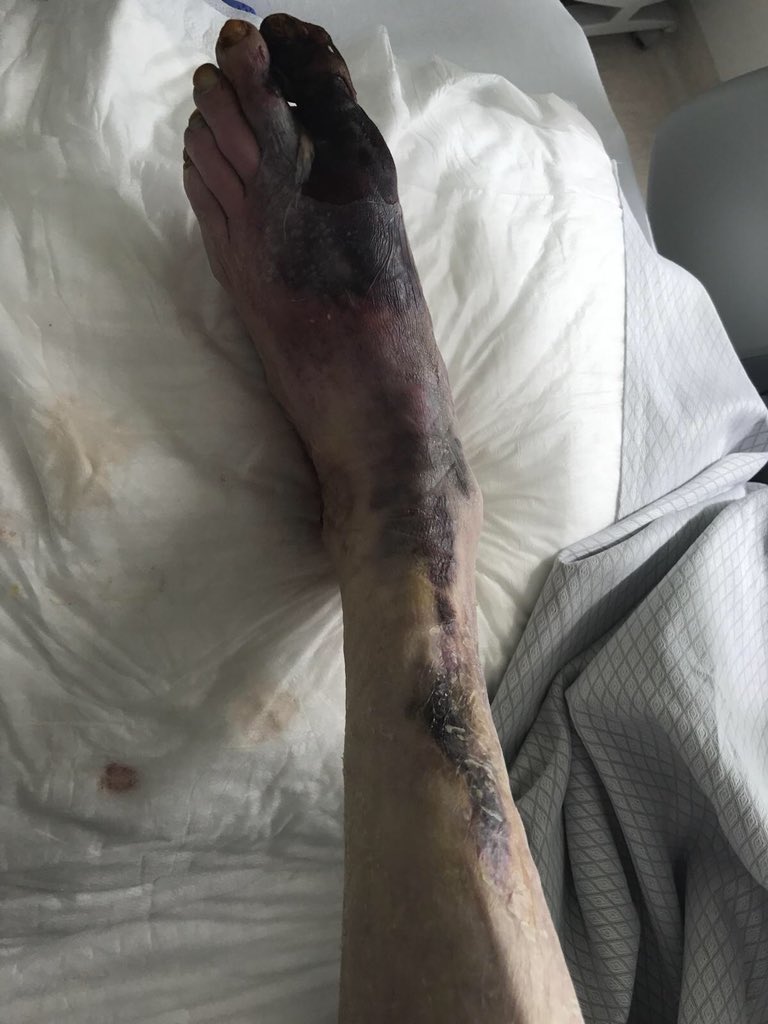 diabeticfoot1's tweet image. Patients admitted today: is the late referral still acceptable? We are not an amputation prevention centre! Today we are an amputation centre @dgarmstrong @jmills1955 @monteromiguel @antoniomunoa @hendolat @andycas