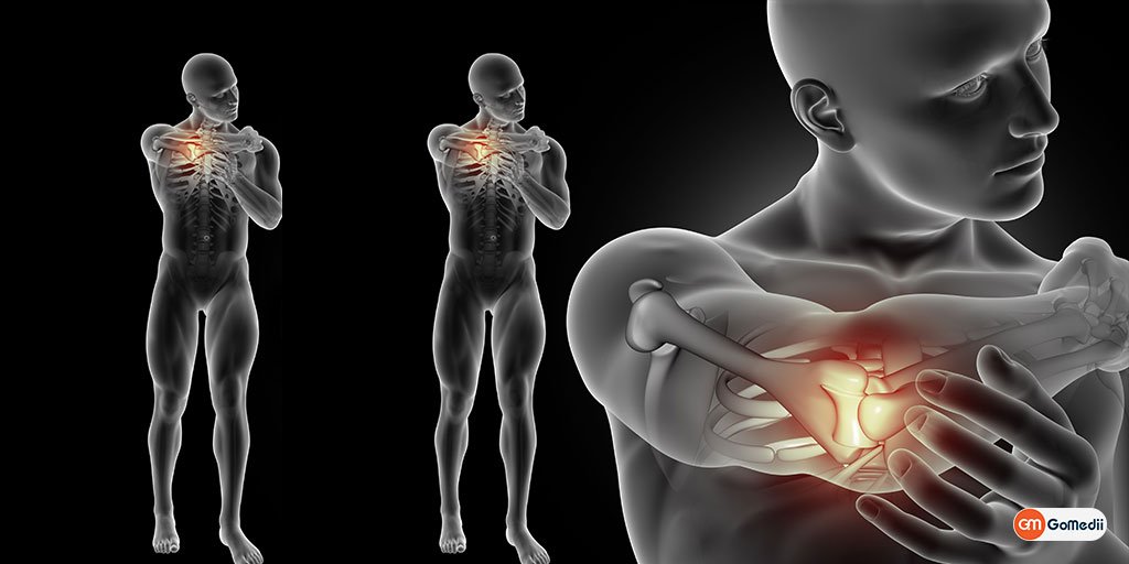 GoMediiOfficial's tweet photo. The Osteonecrosis is a bone-affecting disorder which is developed by over 20,000 people annually. Find out how to tackle this bone and muscle disorder #BoneDisorder #MuscleProblem
https://t.co/pqWIlu3wM5 https://t.co/x6OQv5YPnp