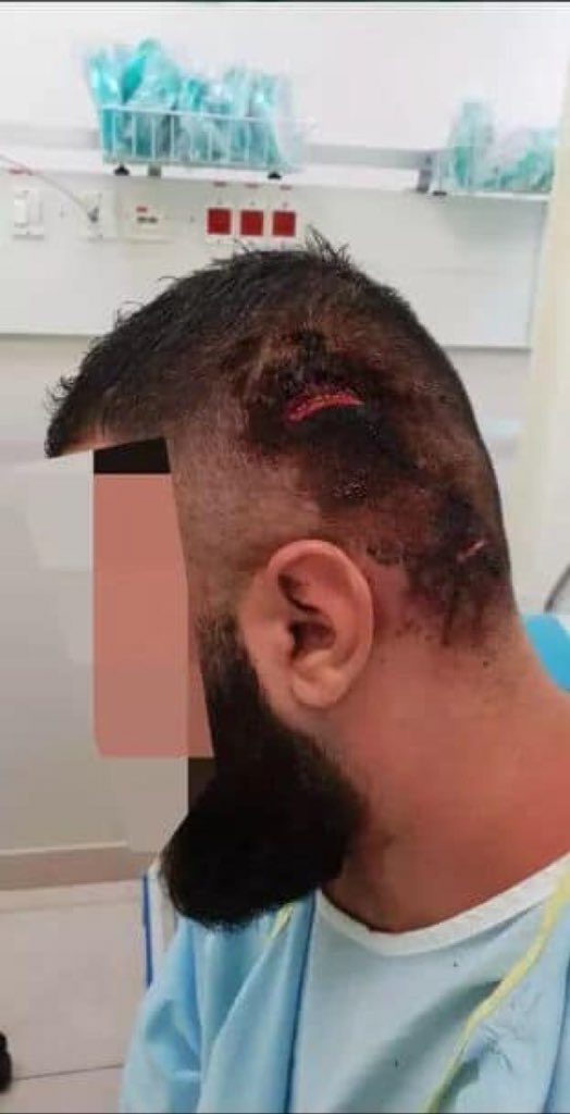 A group of settlers have attacked 3 youths from occupied Palestinian Territories ࿐ questioning them to make sure they were Arabs, then causing various injuries, including head injuries #IsraeliSettlers #GroupPalestine #قروب_فلسطيني