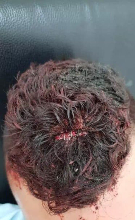 A group of settlers have attacked 3 youths from occupied Palestinian Territories ࿐ questioning them to make sure they were Arabs, then causing various injuries, including head injuries #IsraeliSettlers #GroupPalestine #قروب_فلسطيني