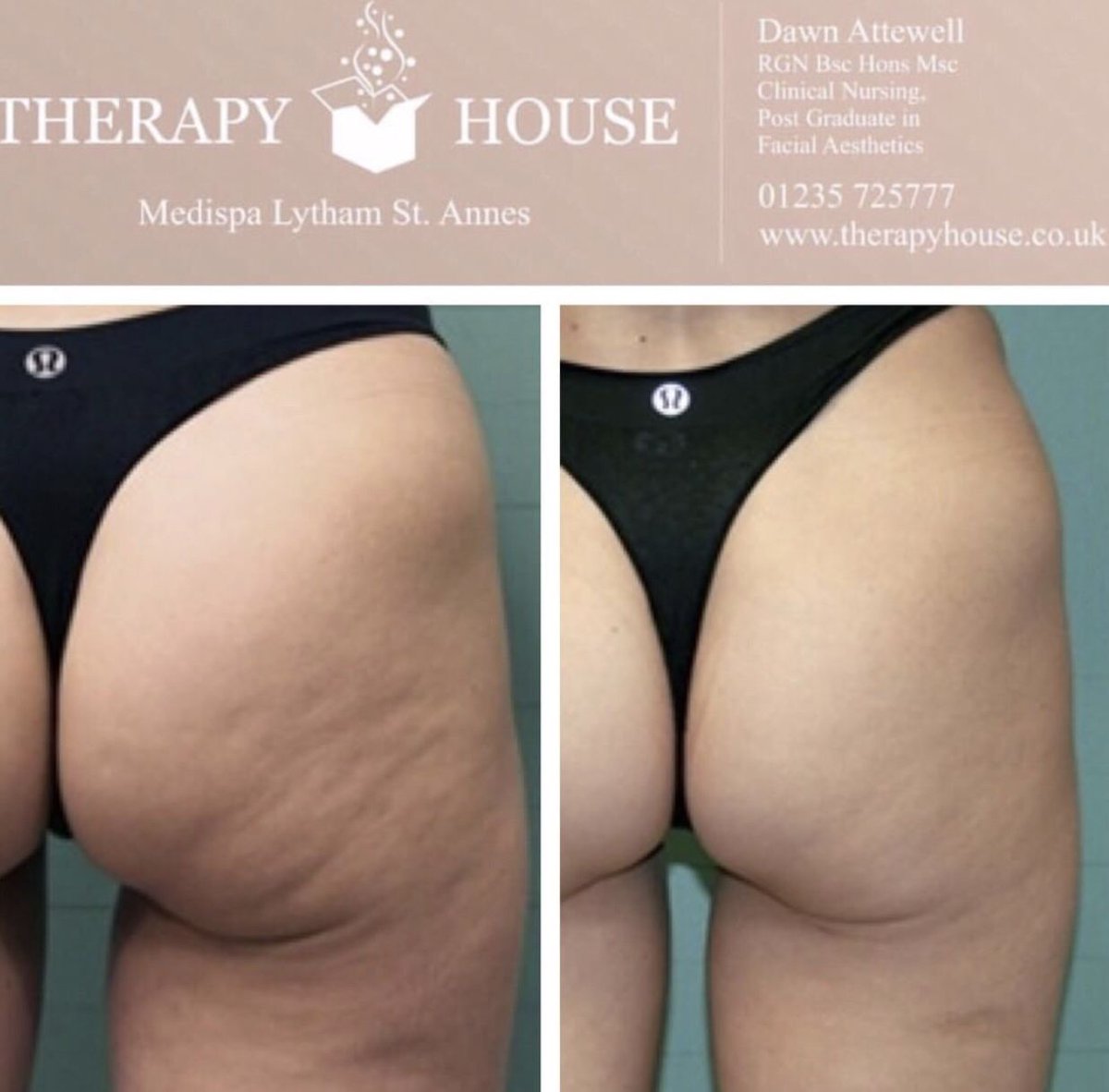 Therapyhouse1's tweet photo. BEFORE AND AFTER ✨ EXILIS ELITE ✨
.
📞 01253725777⠀
💌 info@therapyhouse.co.uk⠀
💻 https://t.co/v7MJNfMPpU⠀
📍 3-5 Back St Anne's Road West, St Annes, Lancashire, FY8 1RD⠀
United Kingdom
•⠀
#TherapyHouse #Skincare #Beauty #beautiful #celebritytreatments #weightloss https://t.co/inHE8nHILv