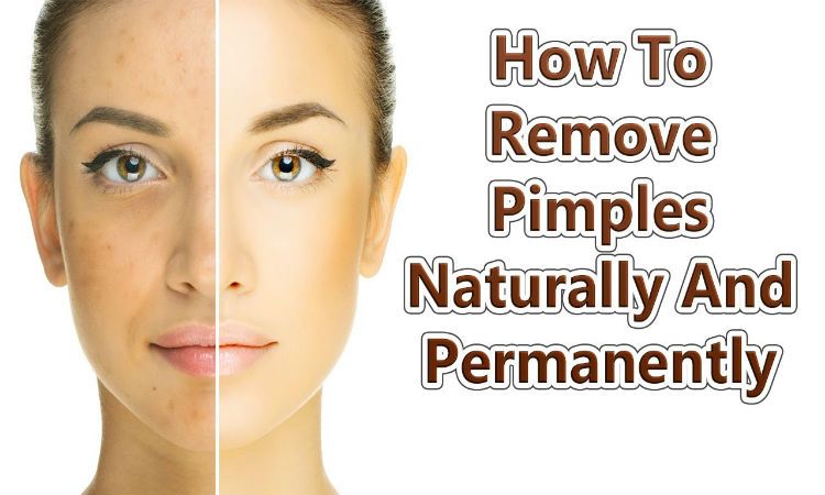 sofiacaligan's tweet image. Natural Ways to Get Rid of Acne – 10 Simple Tips to Remove Pimples Permanently acneskinguide.us/natural-ways-t…