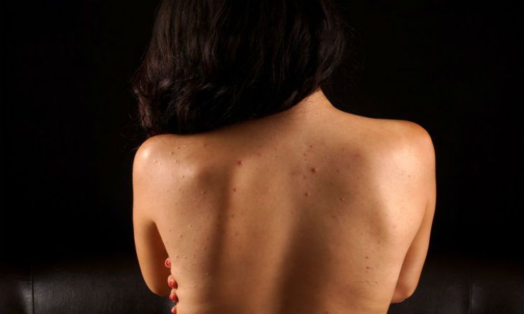 sofiacaligan's tweet image. Back Pimples – Tips For Removing Pimples on the Back acneskinguide.us/back-pimples-t…