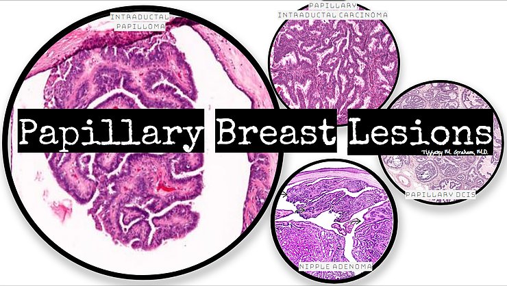 HeartPathology's tweet photo. Here's a quick overview of some common papillary breast lesions. Check out the complete post by clicking the link below.
#PathTweetAward #BreastPathology #HighYieldPathology #Pathforresidents #PathBoardReview
https://t.co/xFzfw22ZYJ https://t.co/GhRISd2Cjw