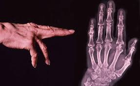 bone_reports's tweet image. Early diagnosis to enable early treatment of pre-osteoarthritis
bit.ly/2kd4YaJ
Journals welcomes you to submit your research work@
bone.imedpub.com