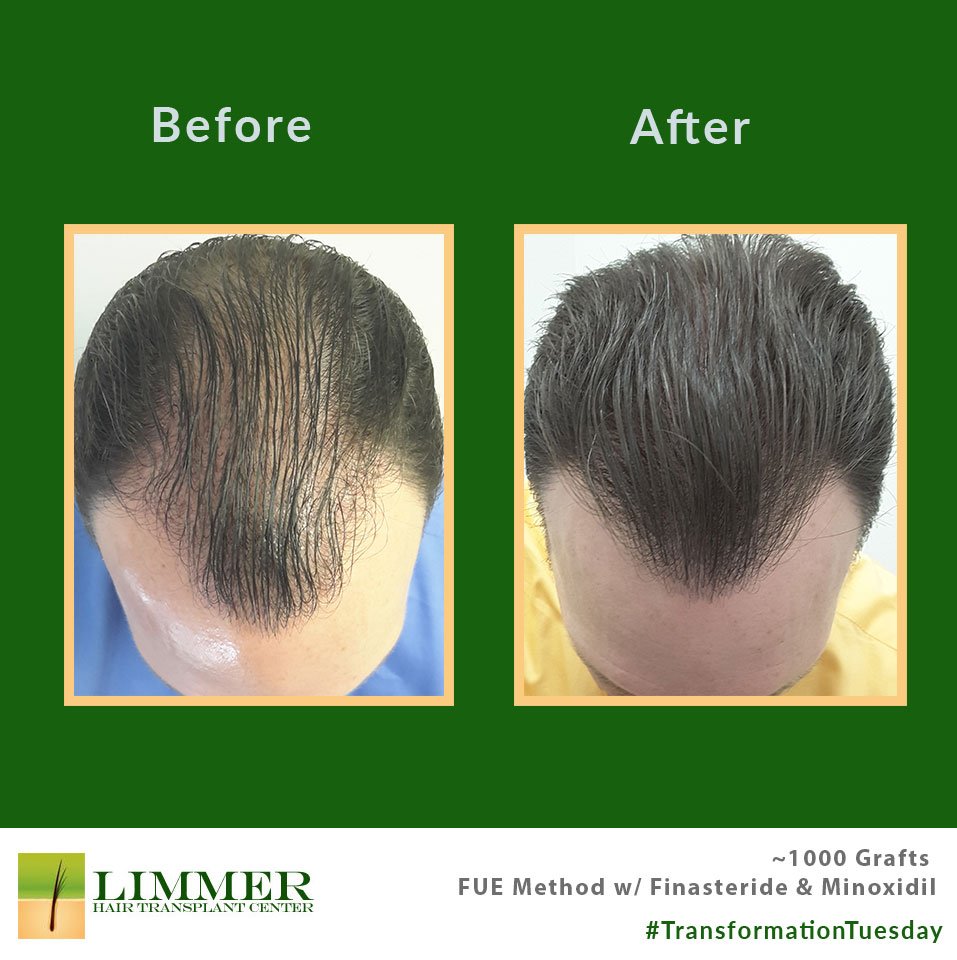 FUE Hair Transplant Case Study  3000 Hair Grafts  Carolina Hair Surgery