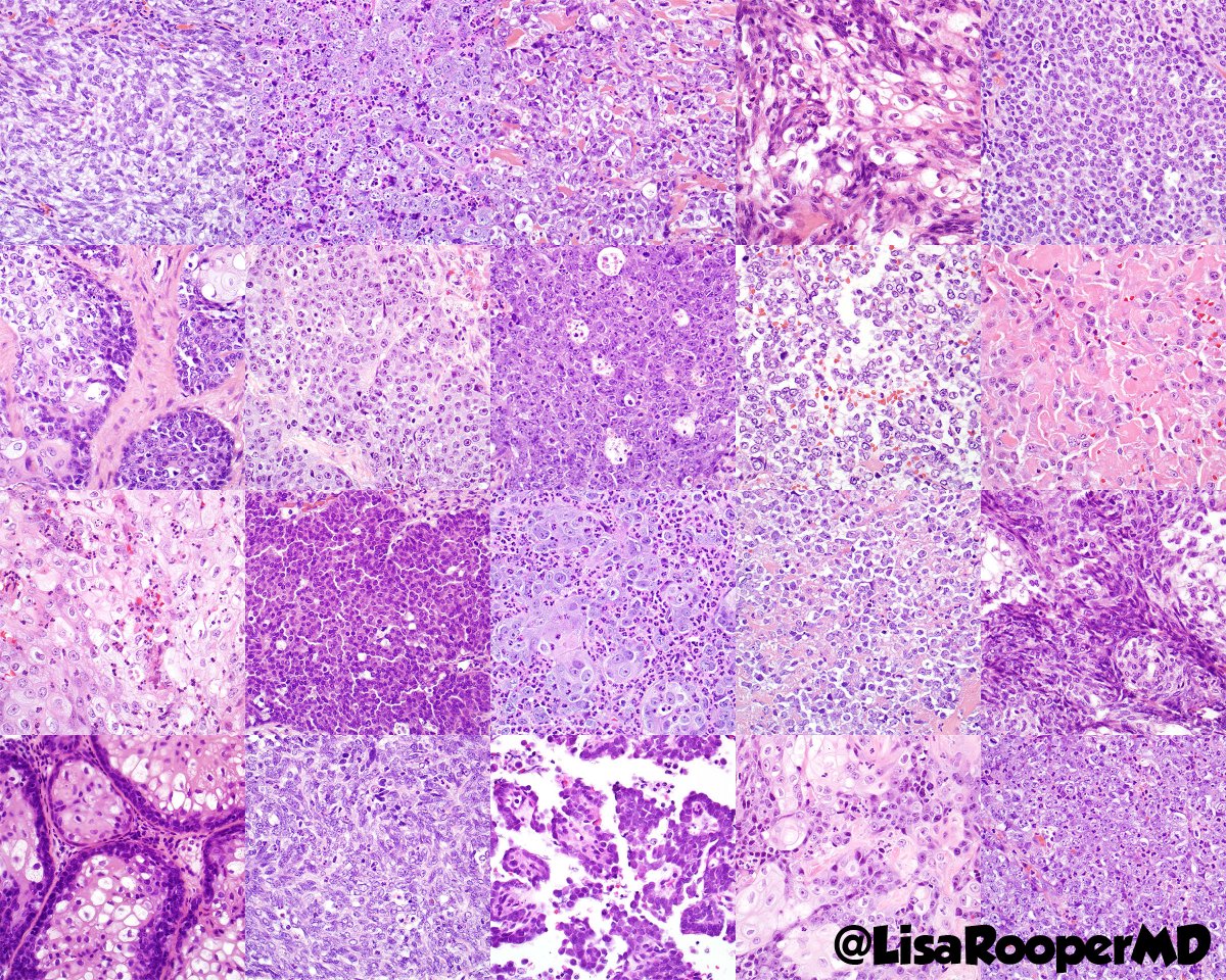 LisaRooperMD's tweet photo. A morphologic mosaic of NUT carcinoma: monotonous primitive cells, basophilic to clear cytoplasm, abrupt keratinization, prominent tumor infiltrating neutrophils. Confirm with speckled nuclear positivity for NUT1 IHC, BRD4-NUT fusion or variants. #ENTPath #PulmPath #SurgPath https://t.co/N4SseW7FeB