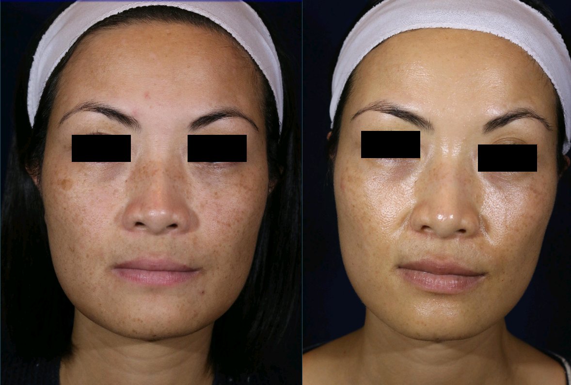 For sun damage, I recommend the Clear + Brilliant Permea laser. Known as the “mini Fraxel,” this gentle laser requires no downtime, but can be used to treat uneven skin texture, reduce the appearance of pores, and improve skin elasticity.