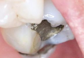 DentistryIQ's tweet photo. Lichen planus: Patients are asking if amalgam removal would help ... What do you say to patients when they ask if their #amalgams are the cause of certain kinds of oral #lesions? https://t.co/JrcKRRg6Mt #dentistry #dentists #dental https://t.co/l36q9LK4x0
