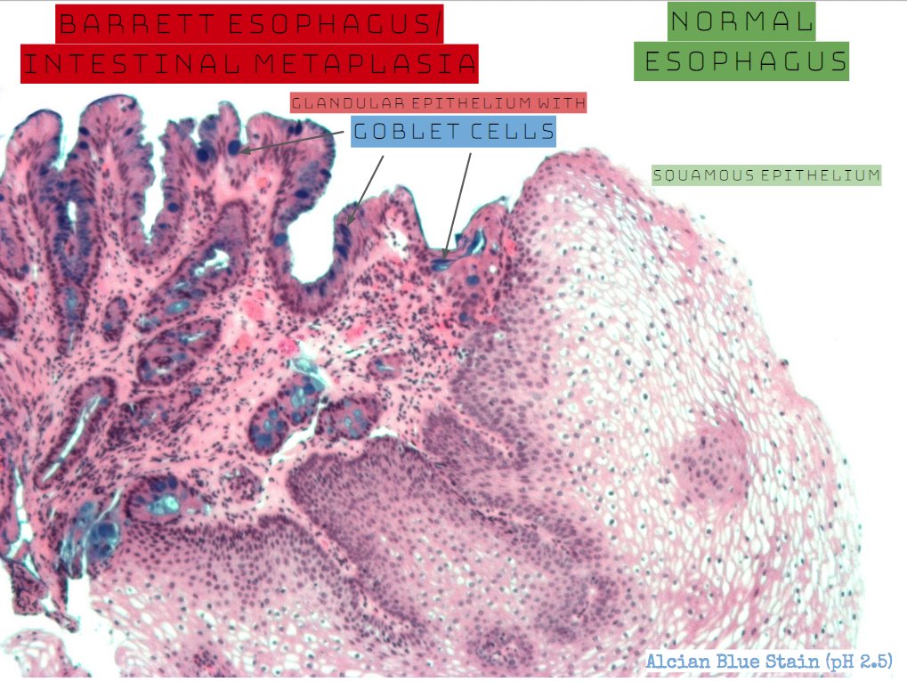 HeartPathology's tweet photo. Transitioning to the GI world. High yield review of Barrett esophagus.
See the full post at link below
https://t.co/LKX20DFshG
#PathTweetAward #IHeartPathology #GIPath #PathforResidents https://t.co/j3qAPR3FDo