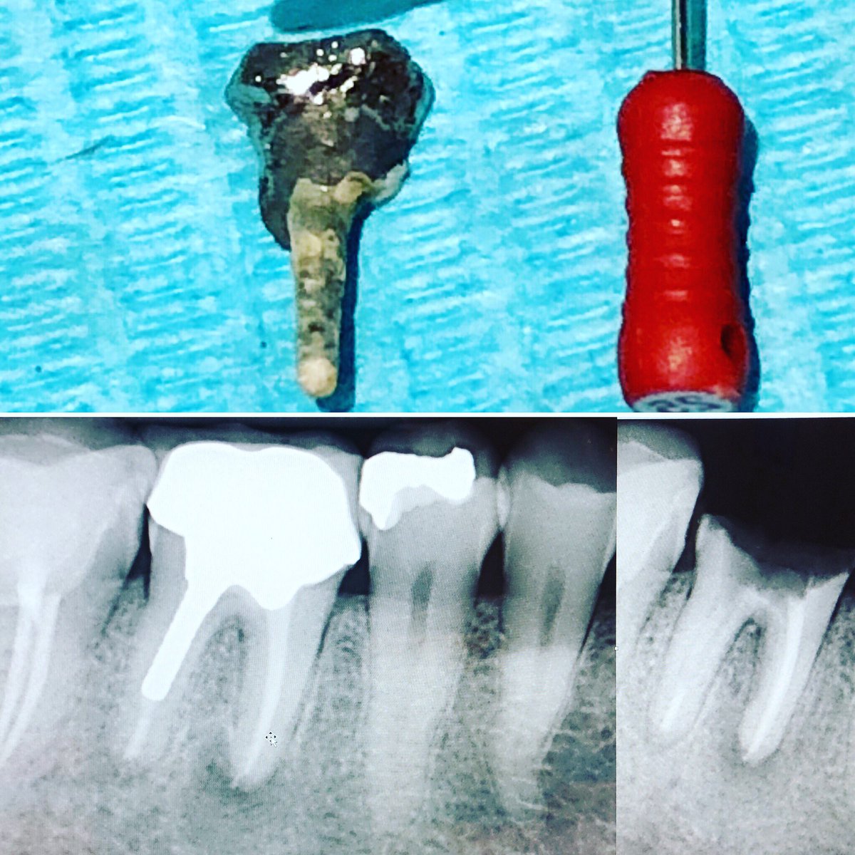 drSarhan4's tweet photo. Dear #dentist please don’t #extract teeth , #extractions should be the last solution after trying all the possible or impossible ways to save a #tooth , it will take time , but it #worth fighting for , so next time you’re facing a casted #postandcore ,,,,#imposibleisnothing https://t.co/0FcOd9UI5Y