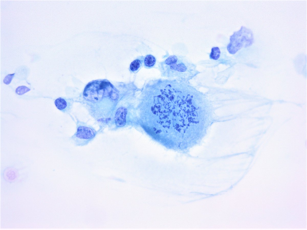 Patholwalker's tweet photo. Mitosis collection. Ascites, cytology. Papanicolaou and DiffQuick stain. #pathology #Cytopath https://t.co/N4JLhbuKMp