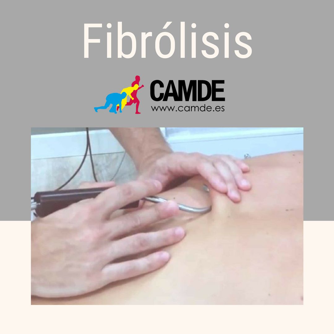 CAMDE_es's tweet photo. La #Fibrolisis es una de las múltiples técnicas que realizamos en nuestro área #FisioterapiaAvanzada
La técnica se ocupa de restablecer el tejido mio-fascial, puede endurecerse o adherirse, provocando #Fibrosis
#CAMDE tratamientos para todo tipo de #Lesiones
📲663 216 571 #Malaga https://t.co/6vDPa15bq0