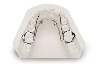 Parents, do you know when your child might need a dental appliance such as this? Leave your comments and check out our latest blog. bit.ly/2ModTsT