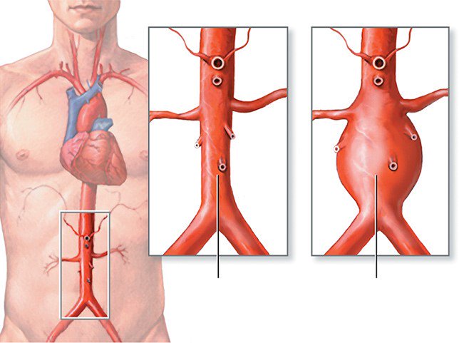 RheveraMedical's tweet photo. Abdominal Aortic Aneurysm (#AAA) risk factors include: age, smoking, being male, being caucasian, family history, atherosclerosis, other aneurysms and high blood pressure. #AAAWednesday #AAAFacts https://t.co/bk1YZ94bVV