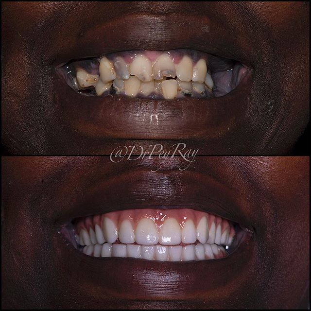 drpeyray's tweet photo. This case was so special to all of us at the office because the patient became one of our best friends, more like family and ended up super happy because that's all she wanted. We love her new smile. We hope you do too🤙🏼🤭 #blessed #beforeandafter #fi… https://t.co/Ftft9eyQV1 https://t.co/em23xvdWe9