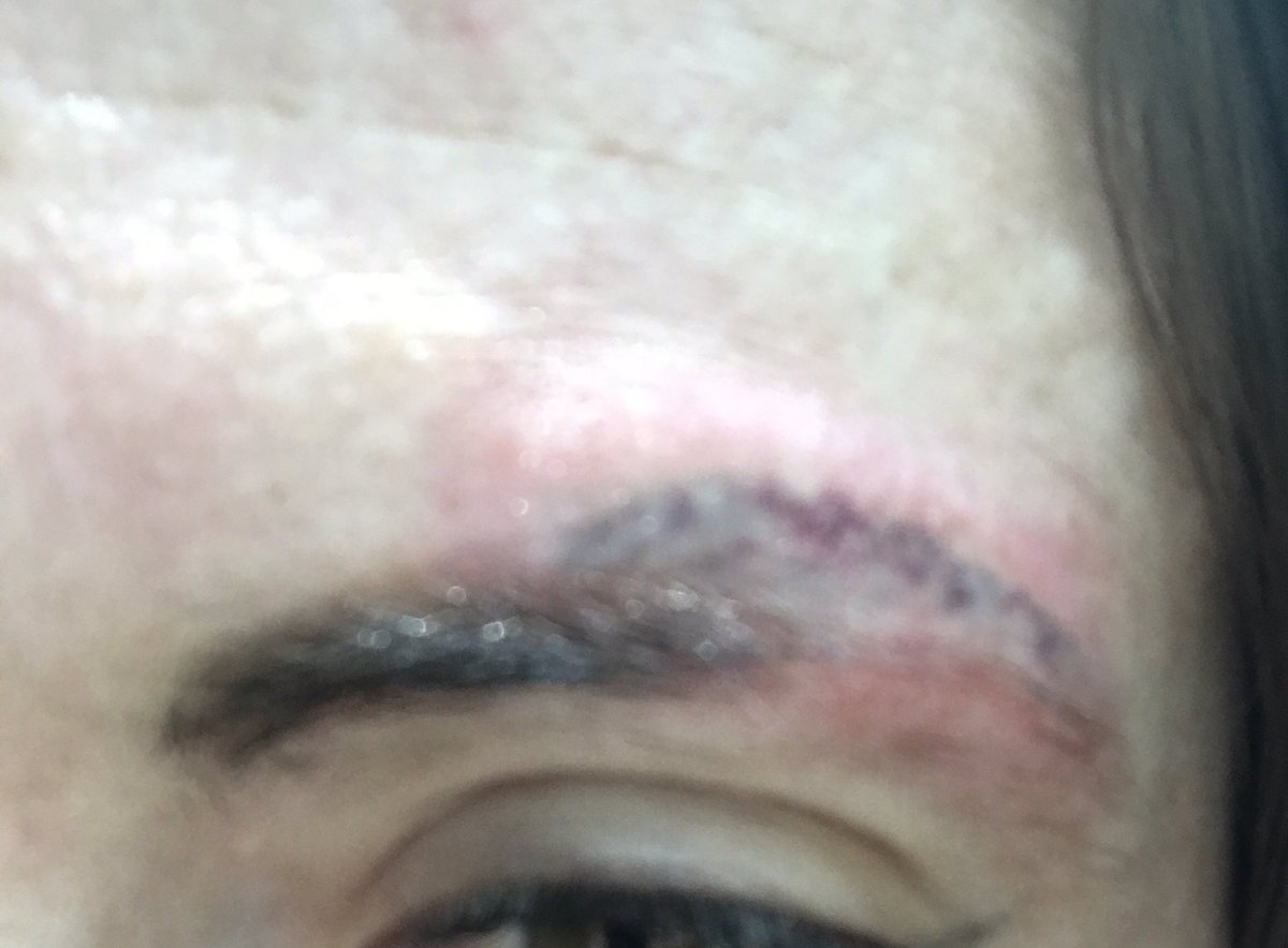 RoVazquezL's tweet photo. Saliendo de una tercera sesión para eliminar el tatuaje horrendo que me hizo @silvia_galvan después de que me arrancó media ceja y quiso cubrir su error. RT para que le llegue que me tiene bloqueada https://t.co/951LvjJ2j2