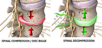 byerschiro's tweet image. #SpinalDecompressionTherapy is a unique therapy directed at relieving the pressure on structures that may be the source of your #pain
Contact Byers #Chiropractic &amp;amp; #Massage to learn more and book your slot! 253-852-1250