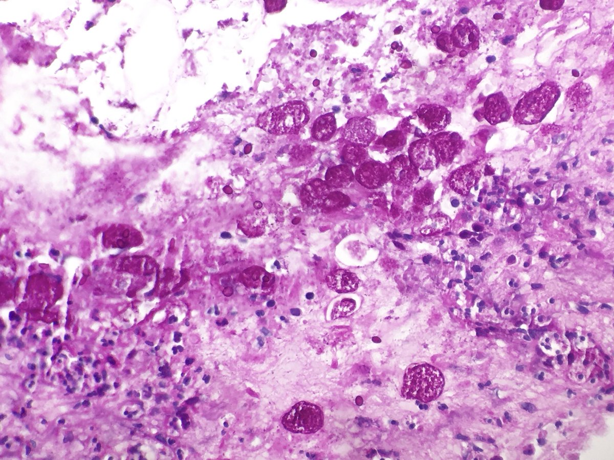 HenryTranMD's tweet photo. “This [slide] reminds me of the ending to ‘Avengers: Infinity War.’” - my 4th yr #medstudent

E. histolytica amoebic colitis. Note distinct nuclear features and ingested RBCs. Stains are H&amp;E and PAS.
#parasitology #Pathology #pathboards #microbiology #GIpath https://t.co/JdkkY7ckrD