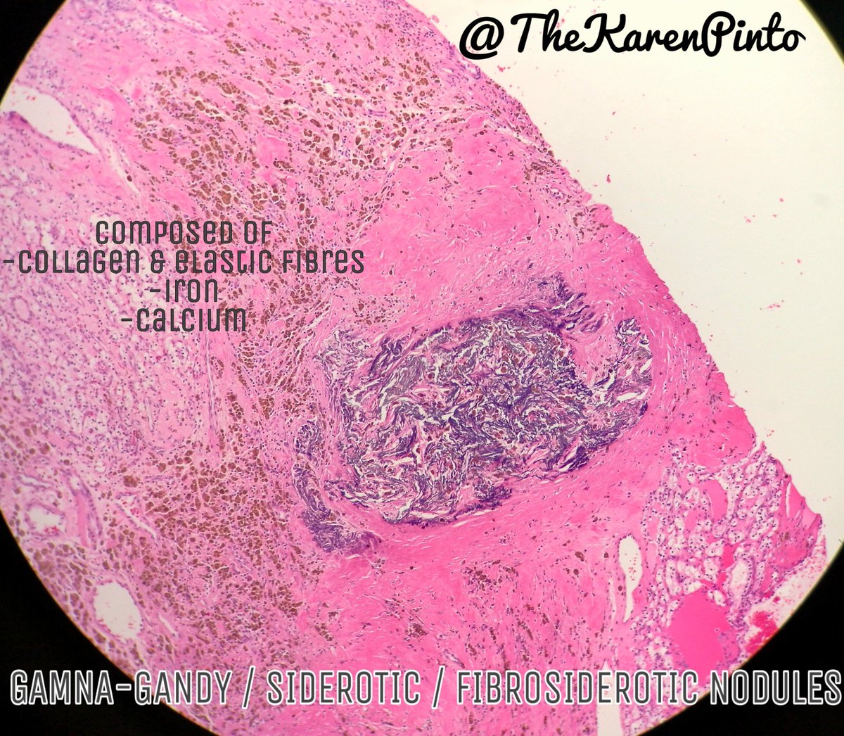 TheKarenPinto's tweet image. GAMNA-GANDY BODIES:

-named after Carlos Gamna (Italian) &amp;amp; Charles Gandy (French)
-were misidentified as fungal hyphae
-can be seen in spleen, cardiac myxomas &amp;amp; rarely lymph nodes, thyroid, CNS

#pathology #GUpath  #Kidney