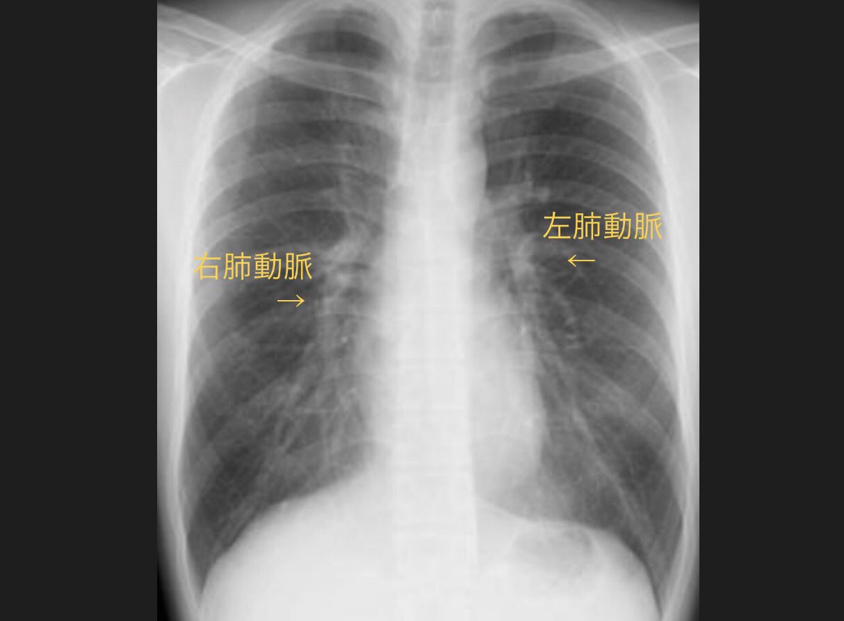Twitter 上的 インヴェスドクター 左右の肺に細いミミズみたいなカゲが無数に出ていますが これは 肺動脈 という血管 です 呼吸をして酸素を吸い込むと 肺の奥からこの血管に酸素がジワジワと溶け込みます その後 酸素豊富な血液は心臓へやってきて ポンプのよう