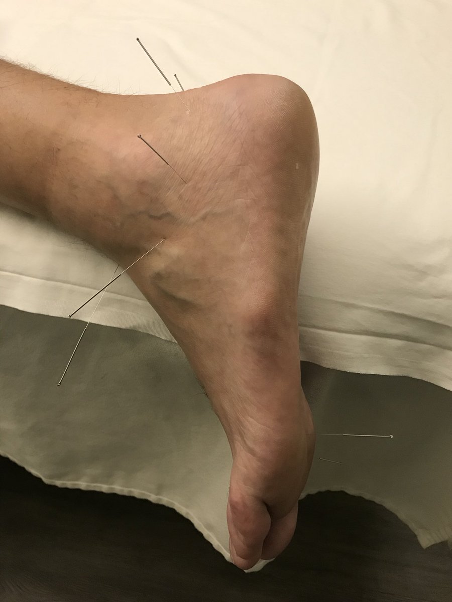 Now trying acupuncture in hopes of getting some relief from the nerve pain in my foot.  Never knew a hip injury could cause so many problems. Life is an adventure! #news9 #kwtv