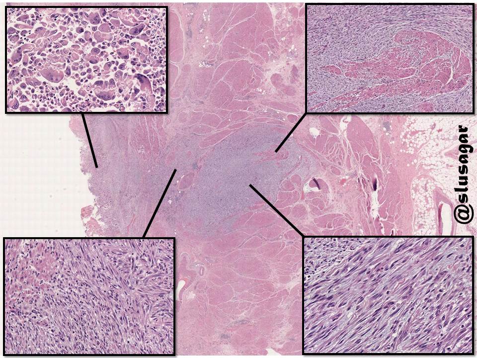 cystectomy done for recurrent pT1 papillary urothelial carcinoma ➡️great #GUpath demonstration of 'post-operative spindle cell nodule' many synonyms, including pseudosarcomatous myofibroblastic proliferation, inflammatory myofibroblastic tumor (IMT, often ALK+)