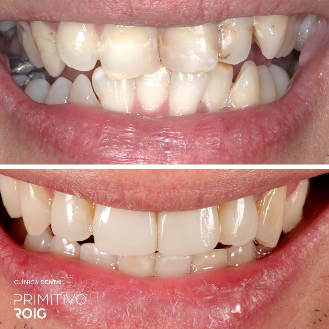 clinicaproig's tweet photo. Confiamos plenamente en la magia de la sonrisa y nos comprometemos al máximo con las personas que quieren mejorar y confían en nosotros. 
#dentistasvalencia #clínicadentalvalencia #odontologíaslow #odontólogos https://t.co/44LQyFPfra