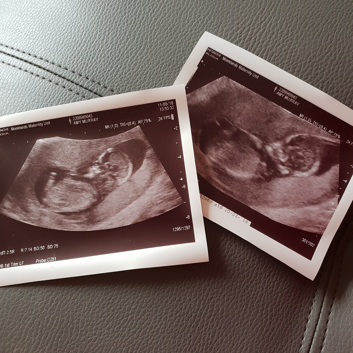 amymurray1690's tweet photo. No words will ever explain the happiness I feel right now 

Our healthy little baby ❤ @CraigGPBFB https://t.co/GRxf8ccBd9