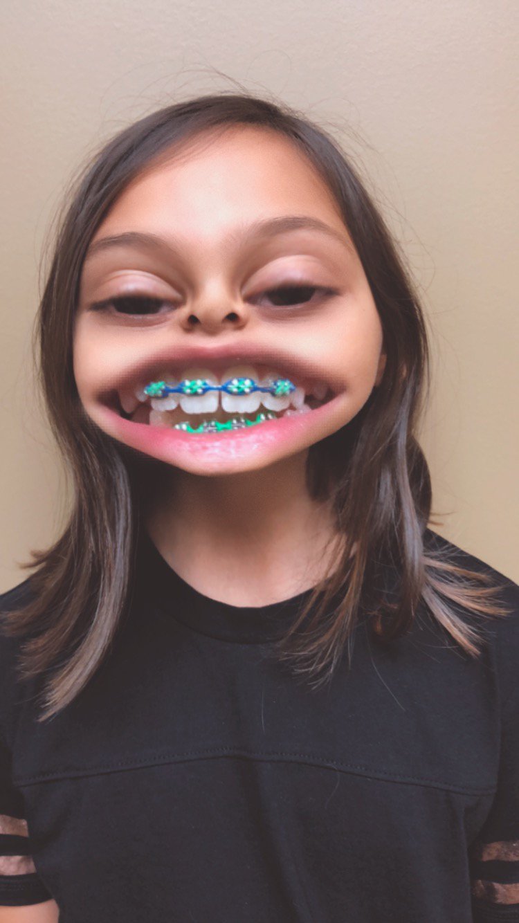 Braces Colors Glow In The Dark