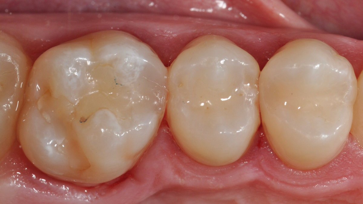 styleitaliano's tweet photo. Don’t miss latest article by dr. Anna Salat “Fillings made fast and easy” presenting a clinical case of our daily practice with composites in which the bulk-fill is used to restore a posterior tooth #aesthetic #dentistry @DMG_DentalNews @DMGAmerica https://t.co/sMpwbrBCnv https://t.co/CUugOB5E30