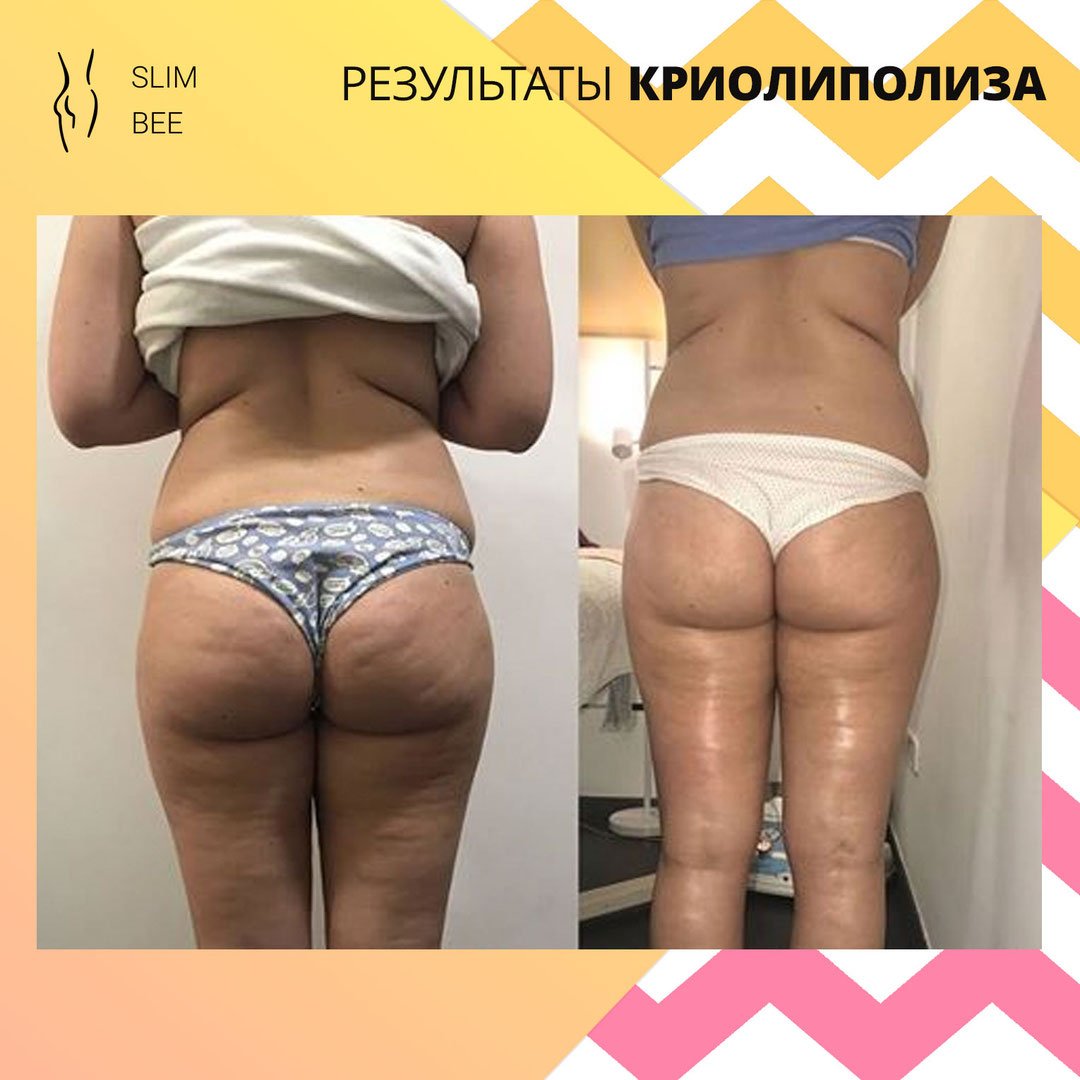 Криолиполиз зоны галифе