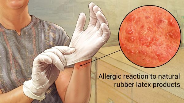 Skin Diseases on X: Latex allergy usually develops after repeated exposure  to latex products, including balloons or medical gloves. Symptoms may  include hives, itching or a stuffy or runny nose. Some people