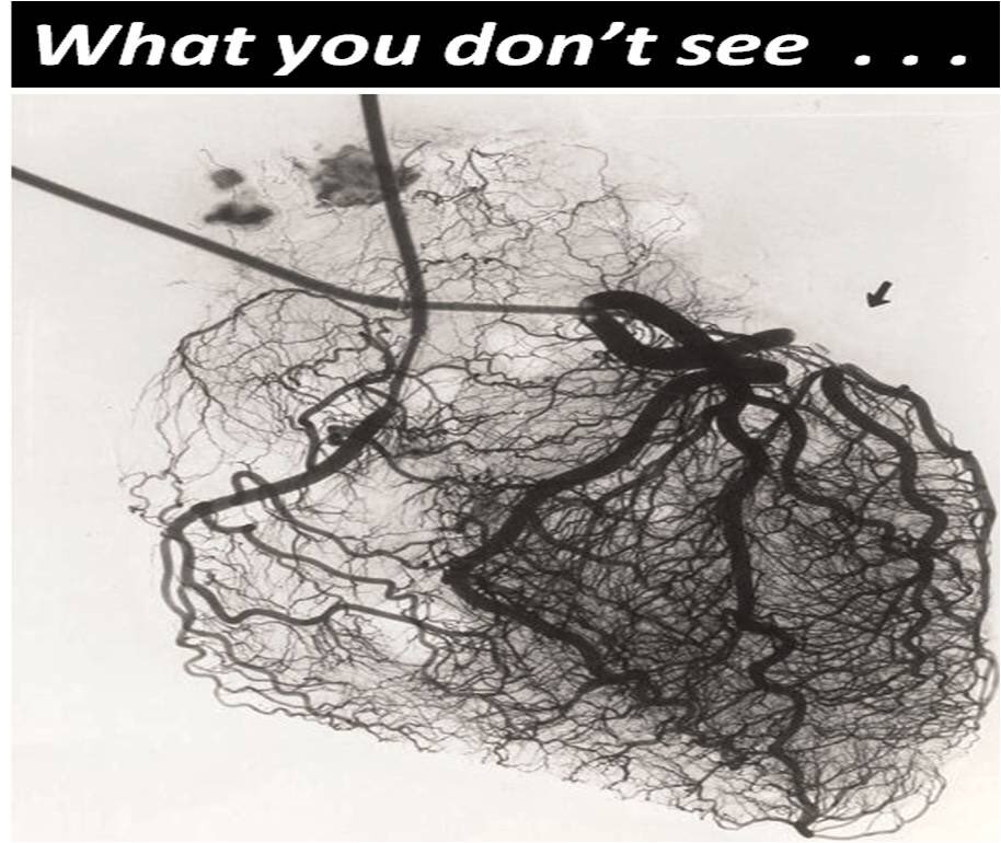 PrecisionPCI's tweet image. The correct answer is 5%! 😳  Never undervalue the importance of FFR and physiology to help guide your decision versus angiography alone. #PCIOptimization #CardioTwitter