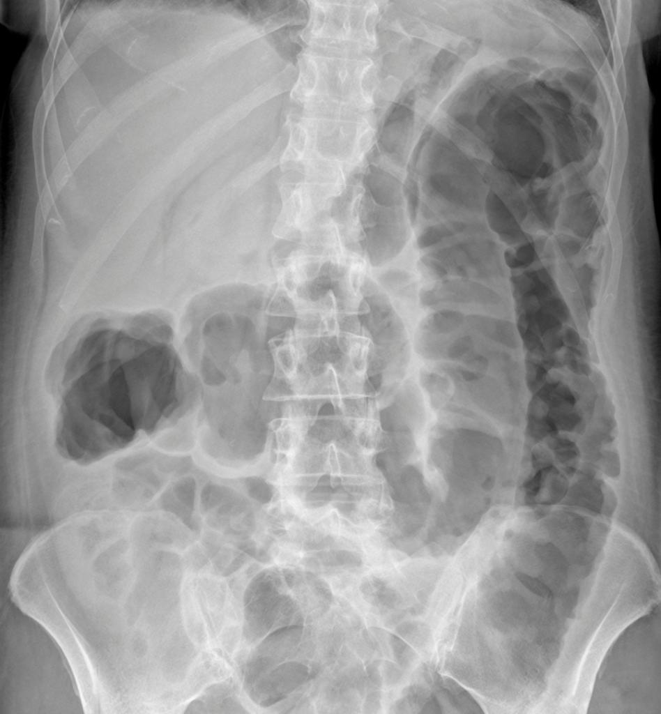 JAMASurgery's tweet image. Commentary: #Eosinopenia and Adverse Outcomes After #Clostridium Difficile Infections ja.ma/2Qpz4ZR