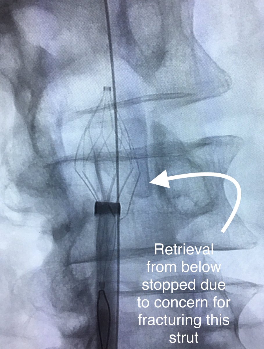 AustinBourgeois's tweet photo. Removal of an optease placed for DVT prophylaxis.  Virtually always require multiple accesses / big coaxial sheaths and counter traction.  Here used 12/18 from below and 16Fr from above w/ a safety wire and Mac anesthesia.  #filterout #iRad https://t.co/ephrp5rzct