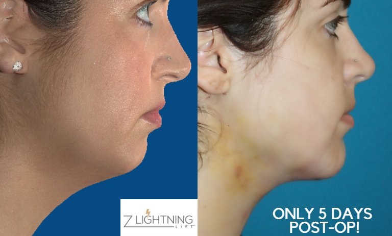 DoctorZuliani's tweet photo. Look at these results just 5 days post #ZLightningLift and #chinimplant!  #WOW  She is beyond thrilled with her more balanced and aesthetically pleasing profile.  #WowWednesday
#drzuliani #zll #necklift #drzuliani #chin #contour #beauty #detroit https://t.co/l6hymZ2m7S