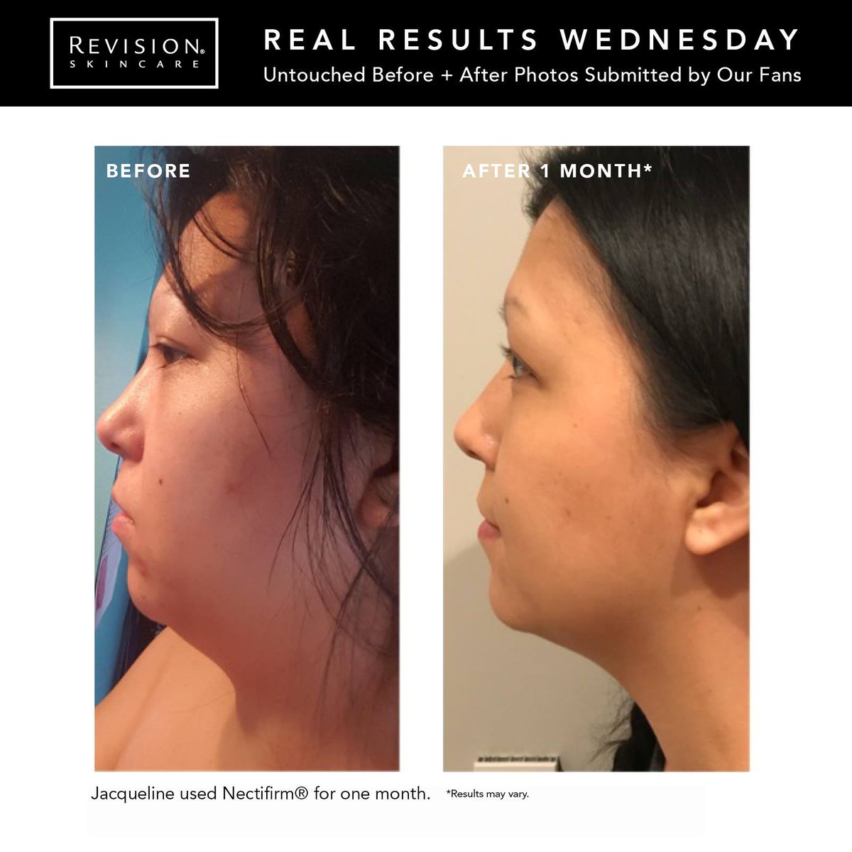 KayalDerm's tweet photo. It’s #RealResultsWednesday!
😲
Look at these amazing results from using @RevisionSkin #Nectifirm for only ONE MONTH ... visibly firmer and lifted skin on her neck! You can reap these astounding results too - call us to get started with #RevisionSkincare https://t.co/H6Rr6hWPmK