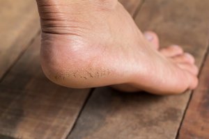 absolutefc's tweet photo. Moisturize, moisturize, moisturize those painful, cracked heels! 💧 https://t.co/4xbiQNioL6 https://t.co/bVAFSMH6P9