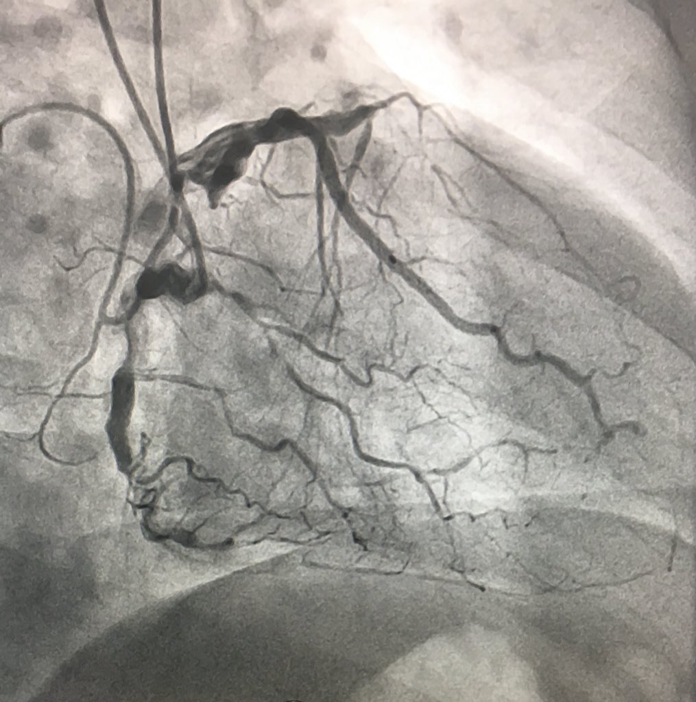 DrFerNunez's tweet image. 58 yo 👨🏻w/ DOE. MI on March taken to PCI of a RI. He has DM, hypertension, EF 42%. SPECT with inferolateral ischemia. Cath videos on reply. What would be your approach for this case? #CTO101 #CTO201 @ajaykirtane @lamelaspablo @saraceciliamtz @hectortamezmd @mirvatalasnag